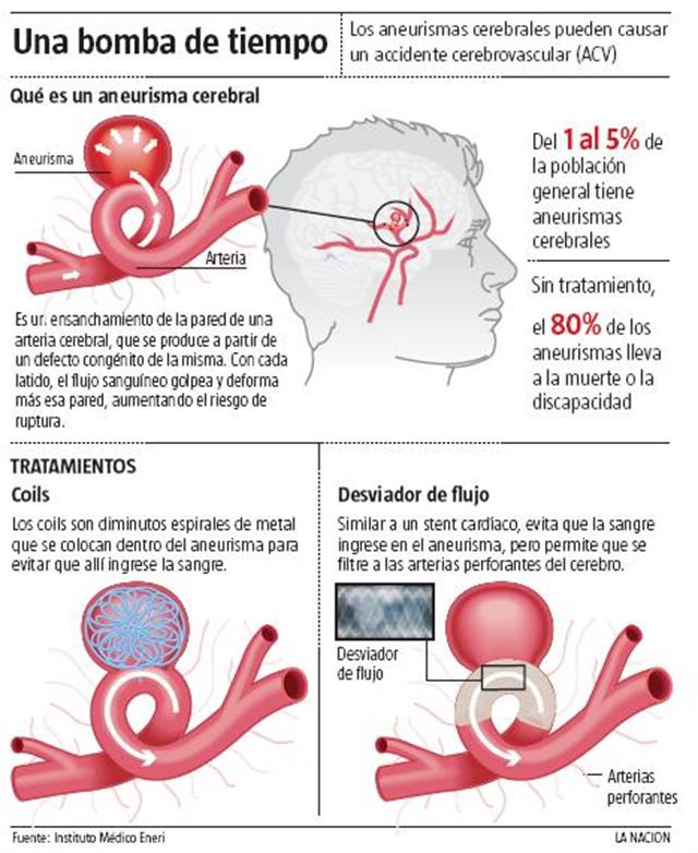 Información de aneurisma cerebral