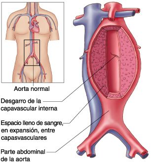 aneurisma aorta